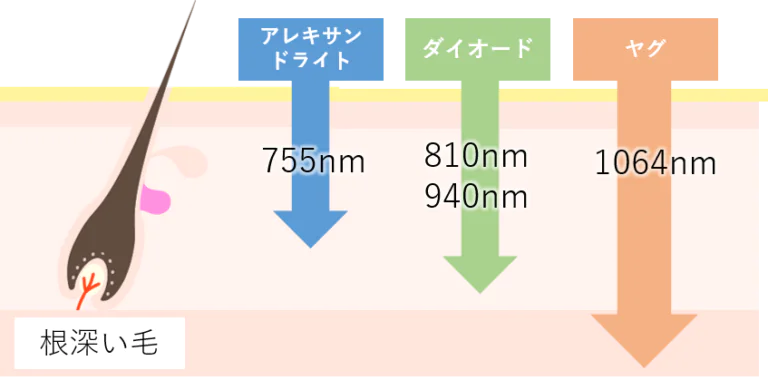 ヤグレーザー搭載機種がおすすめ