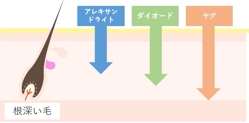 ２種類のレーザー×熱破壊式でしっかり抜ける