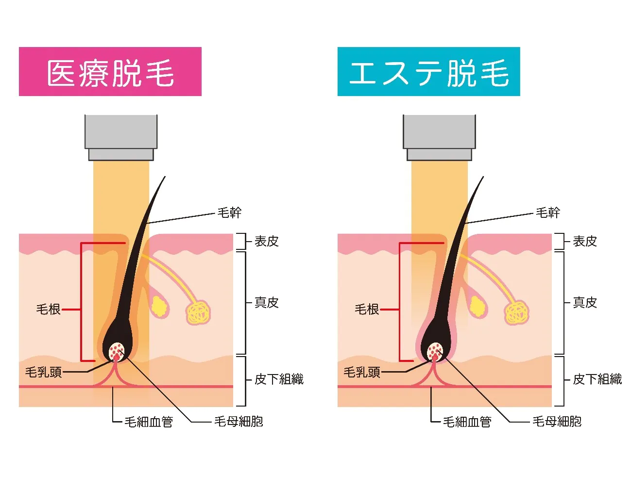 医療脱毛とは