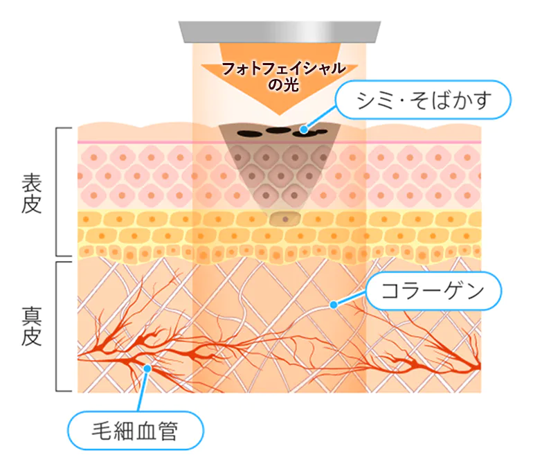 フォトフェイシャルがシミに効くしくみ