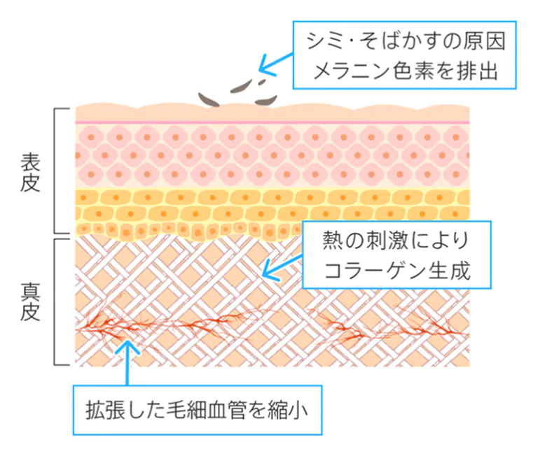 フォトフェイシャルがシミに効くしくみ