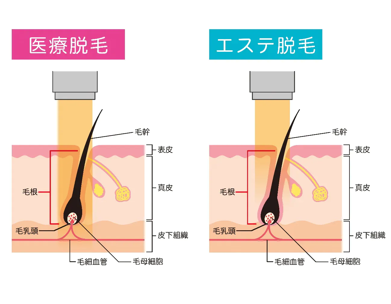 医療脱毛・エステ脱毛