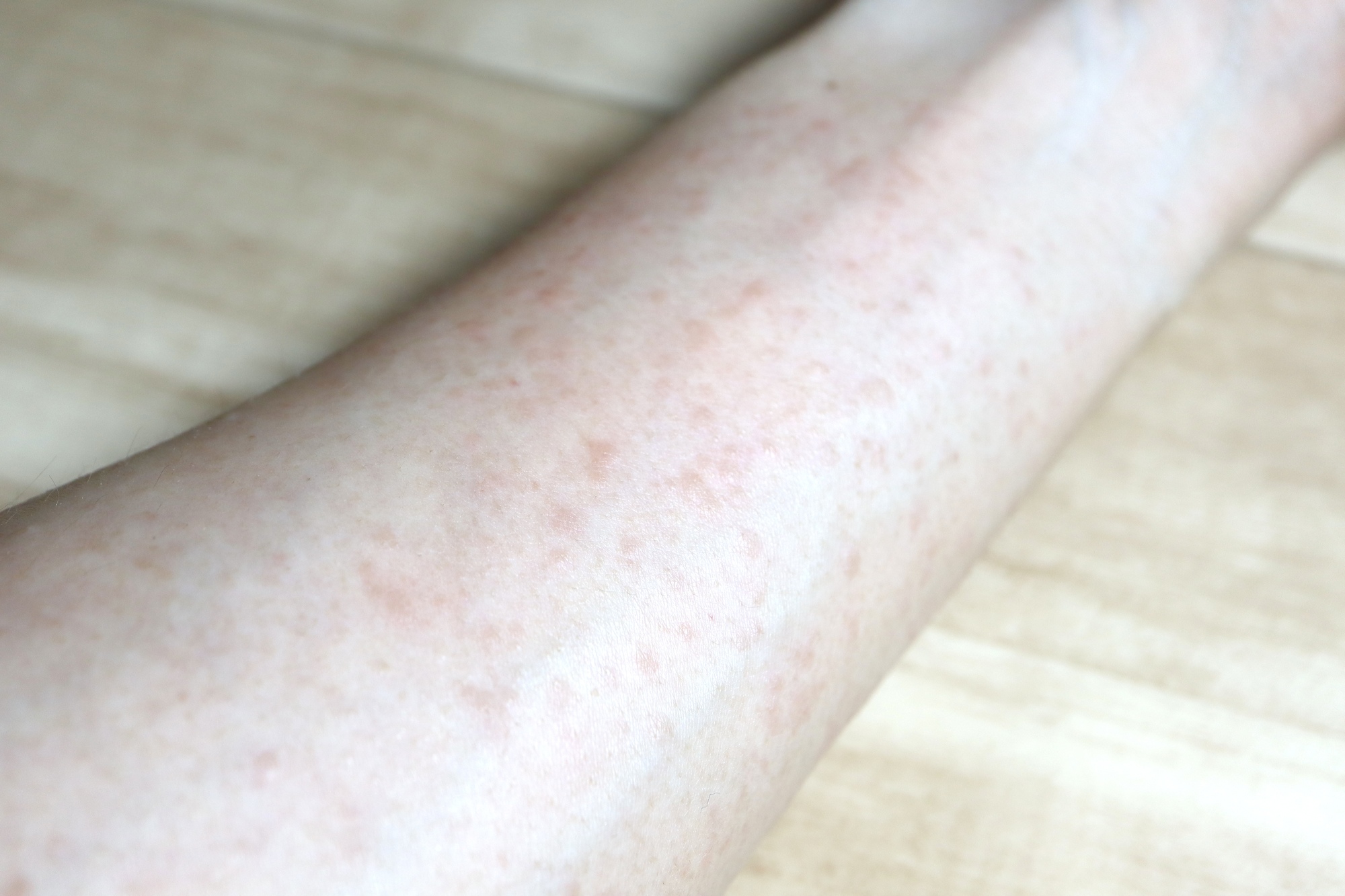 ～慢性蕁麻疹とは～