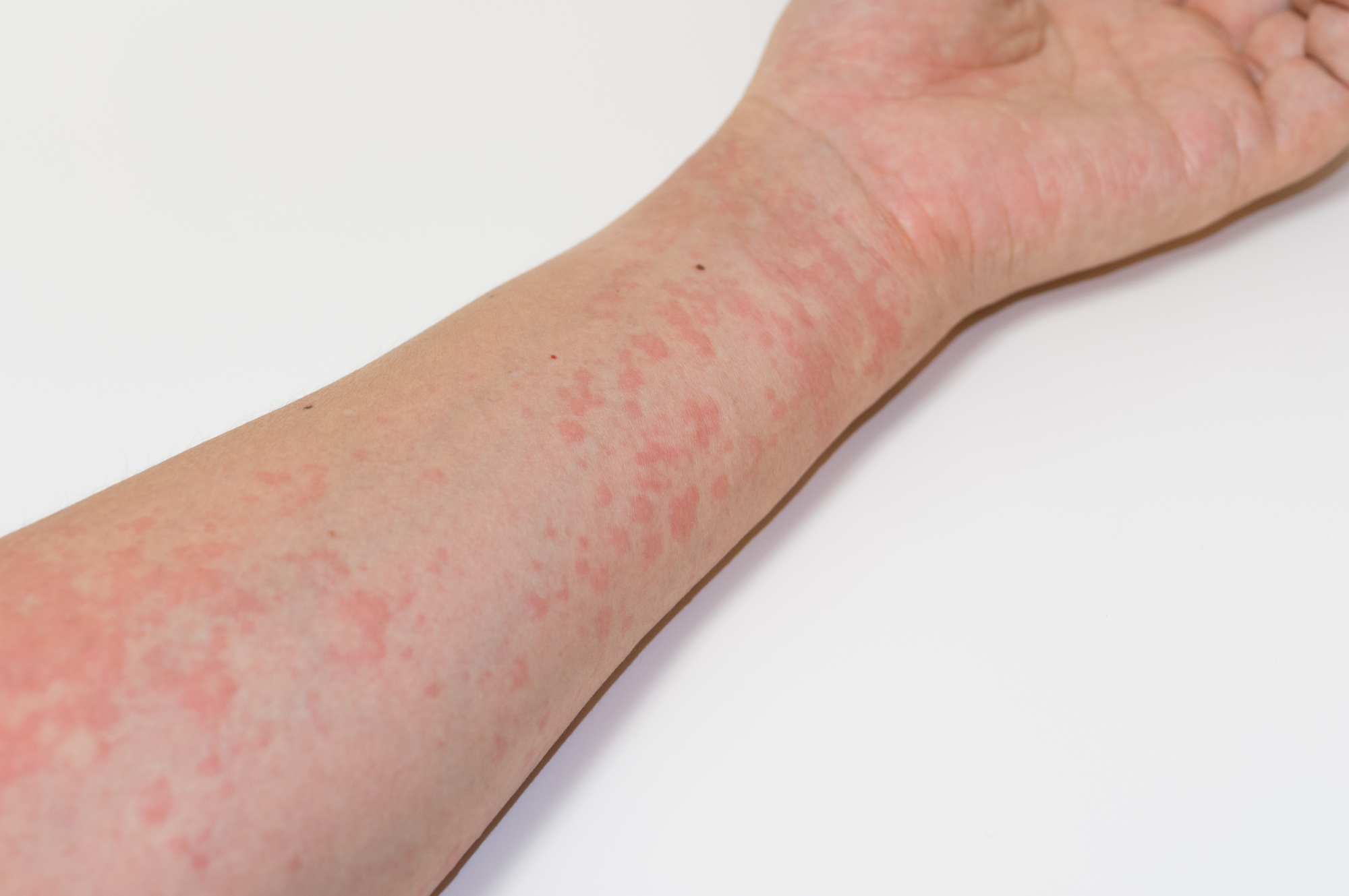 アトピー性皮膚炎とは