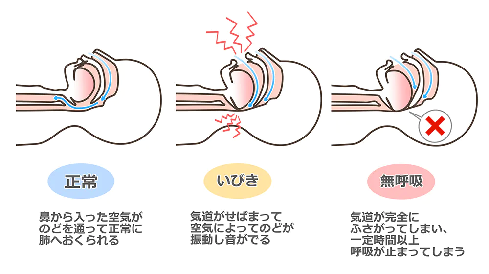 睡眠時無呼吸症候群（SAS）の原因