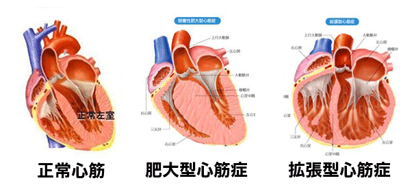 心筋症とは