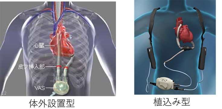 補助人工心臓（VAD）