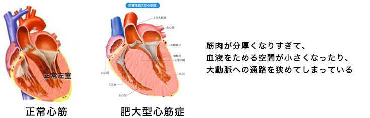 肥大型心筋症とは？