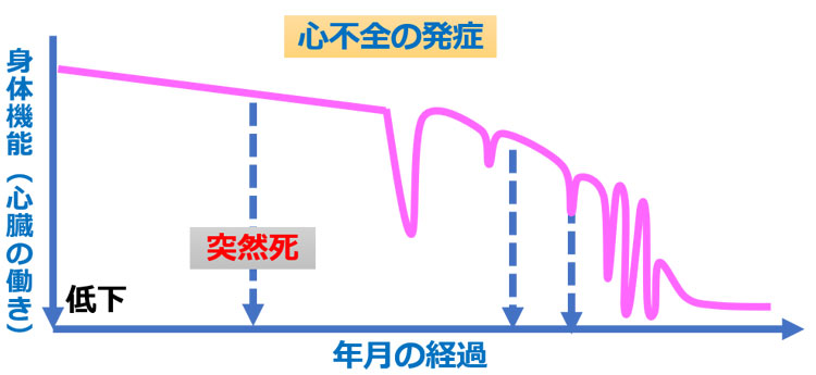 心不全の発症と経過