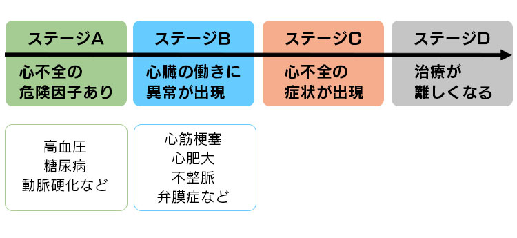 心不全の発症と、ステージ分類