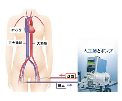 心原性ショック