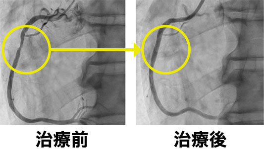 心臓カテーテル治療