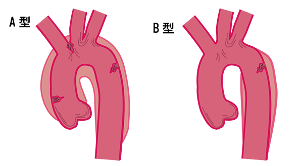 急性大動脈解離の種類