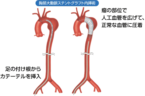 胸部大動脈ステントグラフト内挿術
