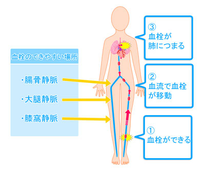 肺血栓塞栓症とは？(1)