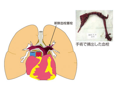 肺血栓塞栓症とは？(2)