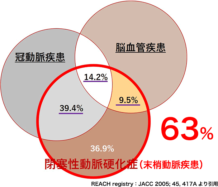 末梢動脈疾患になりやすいのは？