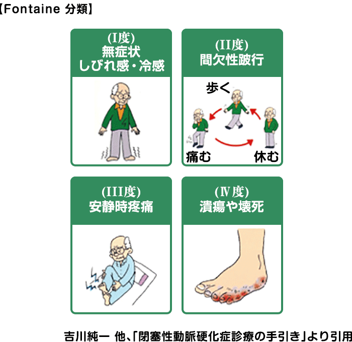 重症度分類（フォンティン分類） 