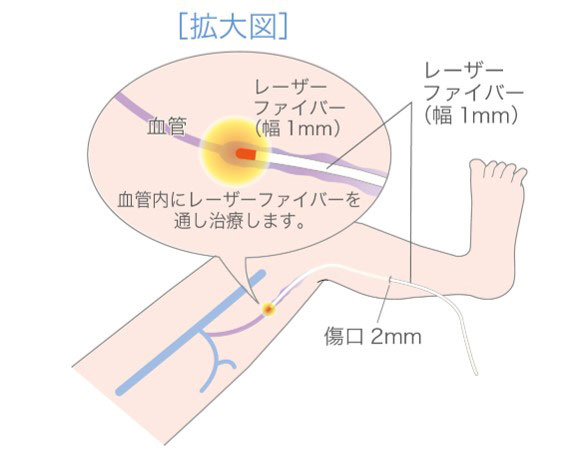 下肢静脈瘤の治療