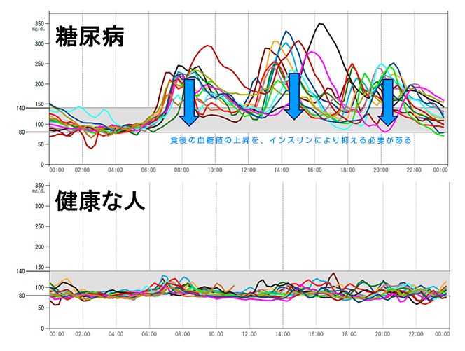 2型糖尿病とは？