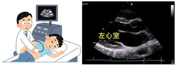 心臓エコー検査