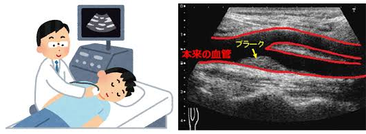 頚エコー検査