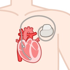 ペースメーカーとは？