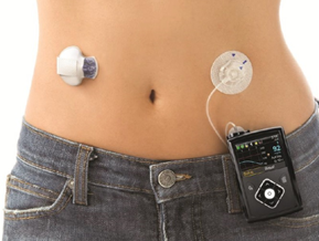 SAP（Sensor Augmented Pump）療法。
左のセンサーから、右のインスリンポンプに血糖値を送り、そのデータをもとに血糖管理を行う。
（メドトロニック社パンフレットより引用）