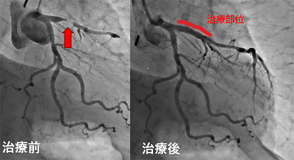 3本ある冠動脈のうち、左前下行枝が閉塞して血液の流れが悪くなった急性心筋梗塞です。