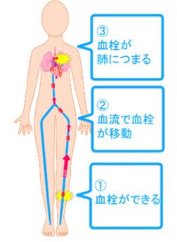 エコノミークラス症候群