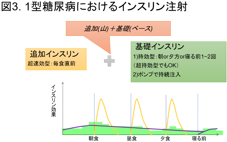 1型糖尿病におけるインスリン注射