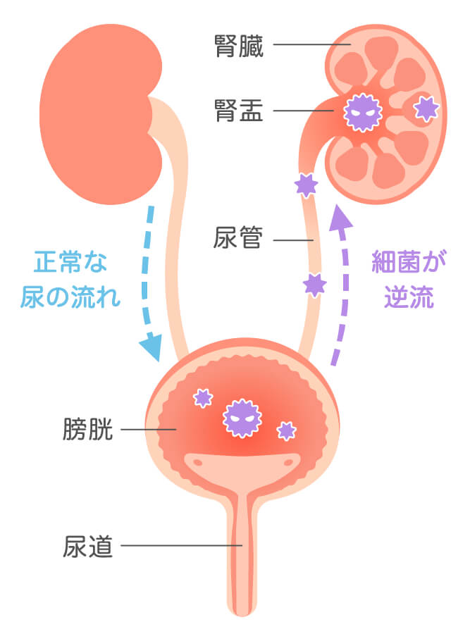 腎盂腎炎の原因と症状