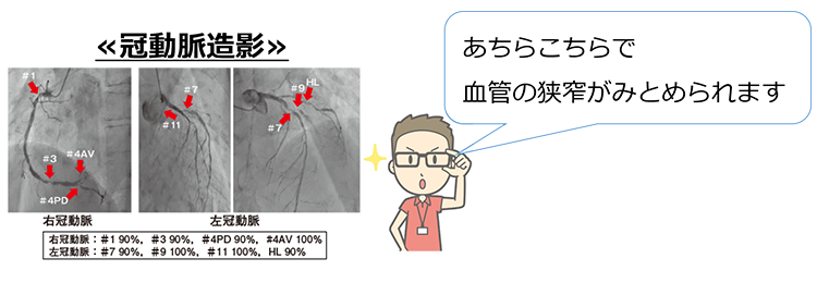 糖尿病における心臓栄養血管（冠動脈）病変の特徴